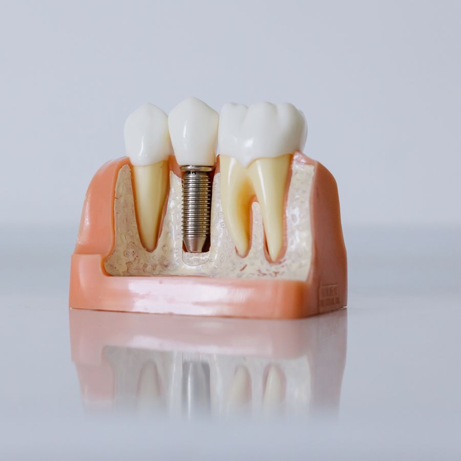 Modelo de implante dentário